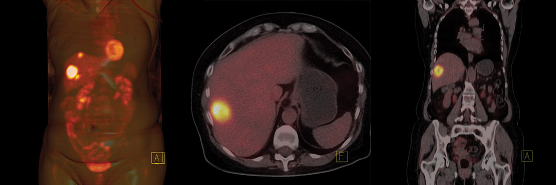Obrazowanie-struktury-i-czynności-narządów-wewnętrznych-metodą-PET